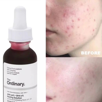 AHA 30% + BHA 2% Peeling Solution 30ml Peeling Solution Exfoliating Facial Brighten Smooth Cleanse Pores and Brighten Dullness